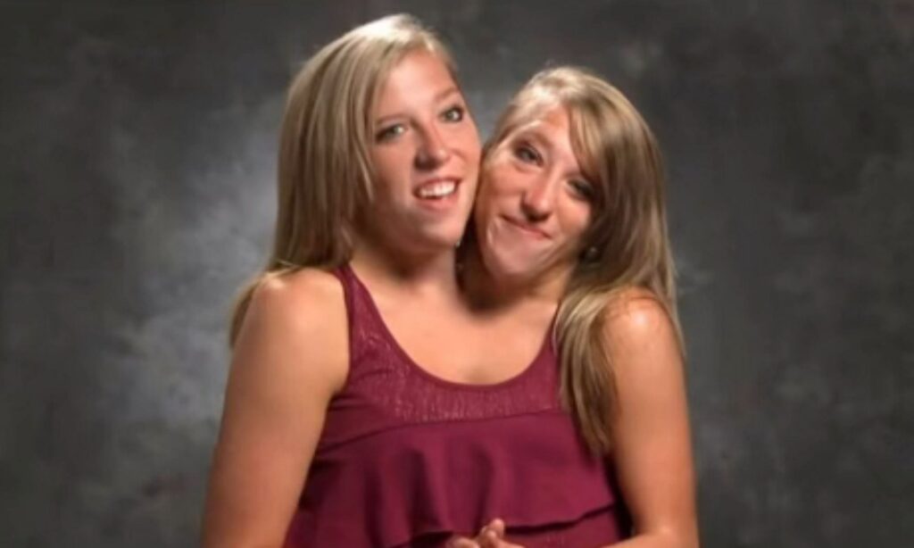 Abby i Brittany Hensel – czy mają męża i dzieci? Niezwykła historia sióstr syjamskich
